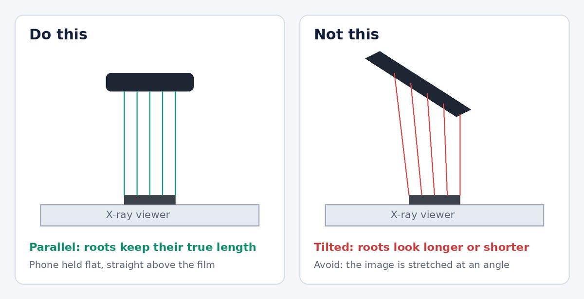 A phone held flat above a film on an X-ray viewer keeps the true shape; a tilted phone distorts it